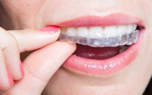 invisalign and clear correct