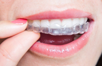invisalign